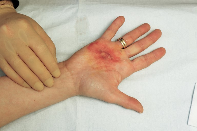 Na de behandeling:  ringvinger is volledig losgeprikt.