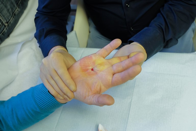 Na de behandeling: ringvinger is losgeprikt, vinger kan nu in overstrek gebracht worden