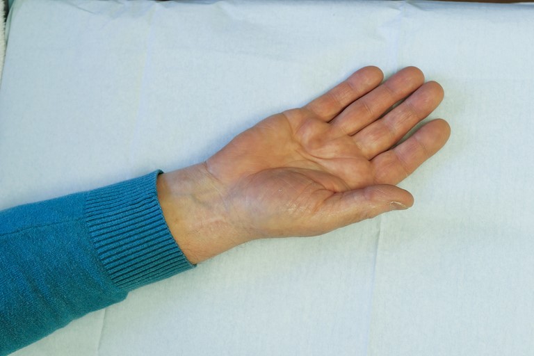 Voor de behandeling: ringvinger is licht aangetast, zonder duidelijke flexiecontractuur