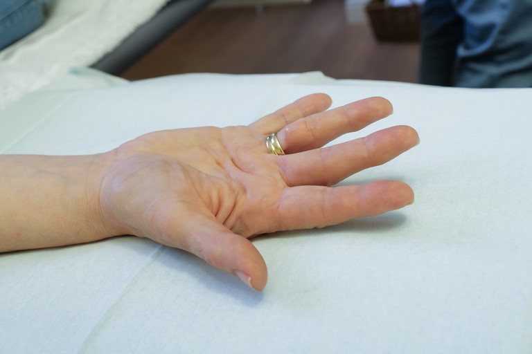 Voor de behandeling: Aangetaste ringvinger met lichte flexiecontracuur